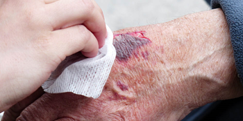 Transfer without tissue damage