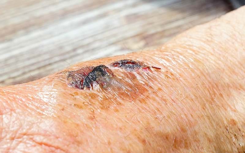 1.5-Year-Old Pressure Ulcer Heals