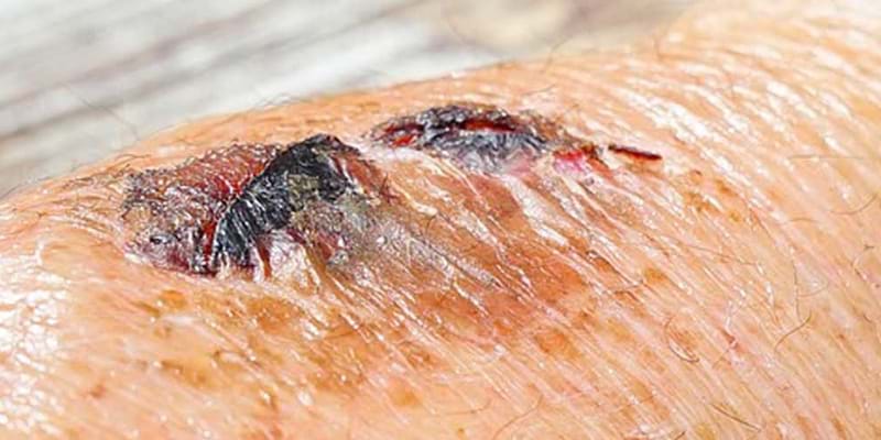 1.5-Year-Old Pressure Ulcer Heals