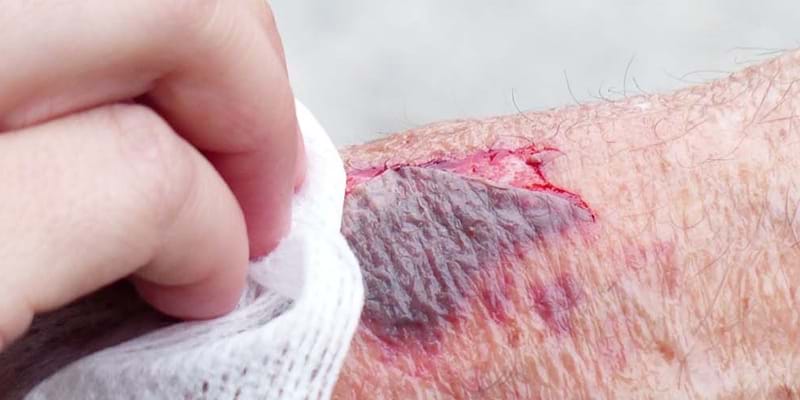 Transfer without tissue damage